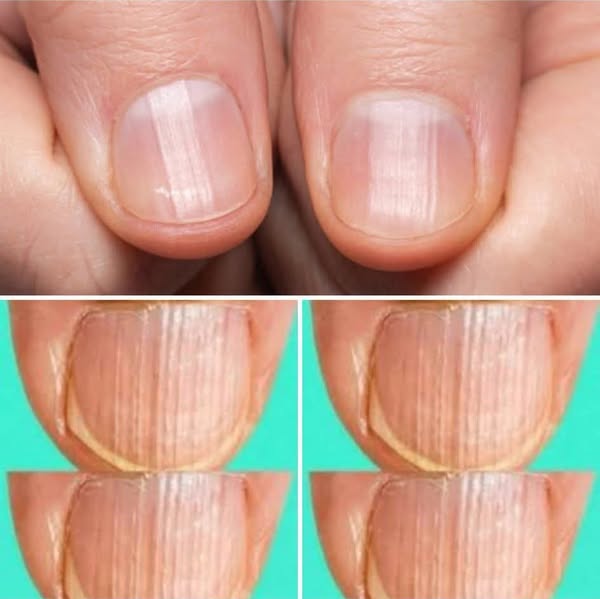 Having Striped Nails Could Mean That Your Body Is…