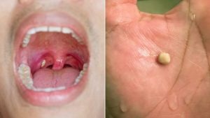 Everything You Need to Know About Tonsil Stones: Causes, Symptoms, and Removal Methods