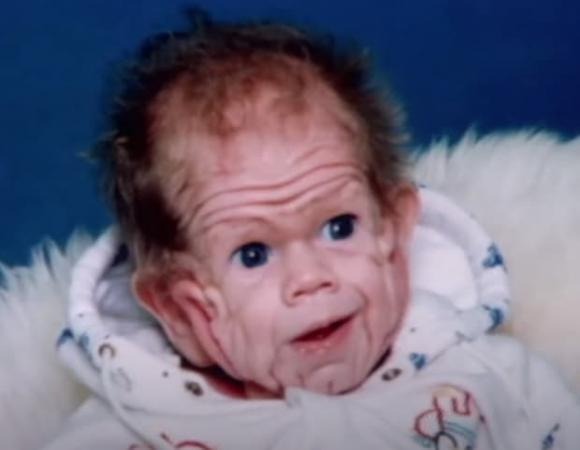 ST3. A newborn with a rare skin condition that baffled doctors was given a very good chance of survival twenty years ago… –