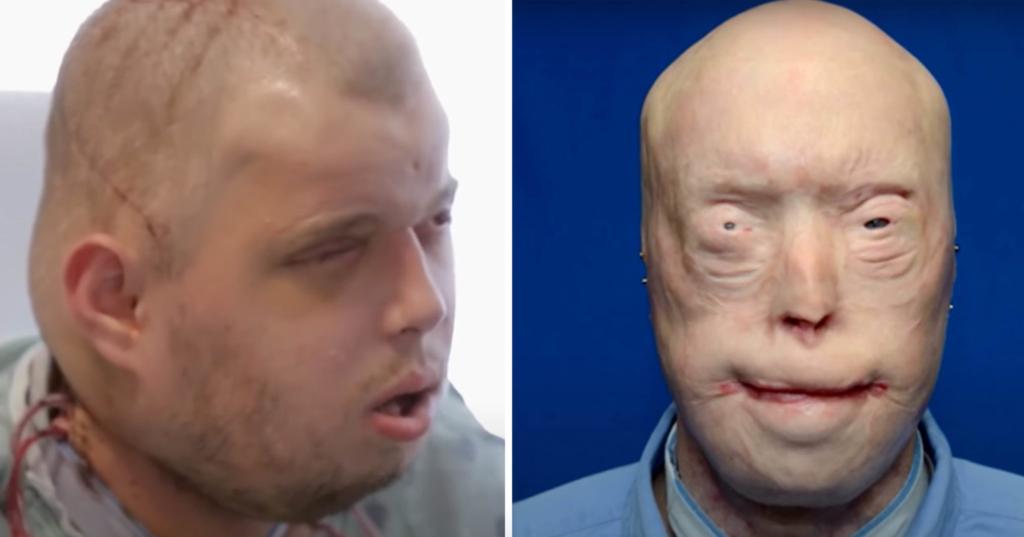 HT1. Brave firefighter has face transplant after suffering third-degree burns, & survives against all odds –