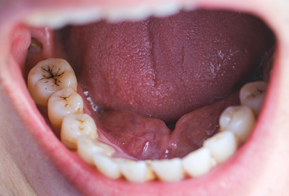 HT1. How to naturally repair a cavity. Keep these tips in mind to avoid visiting the dentist