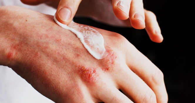 HT3. Warning signs you should never ignore on your skin