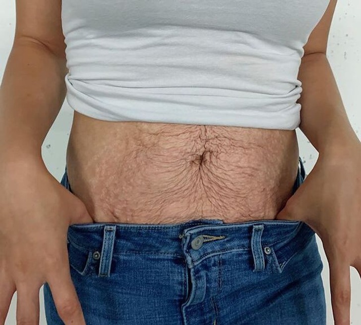 ST15. Woman Shows the Raw Truth of Postpartum Bodies