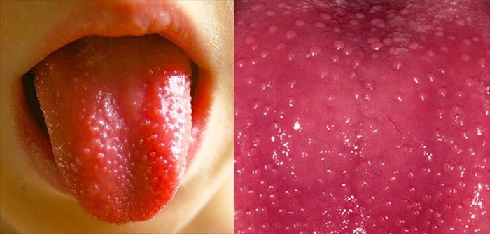 HT3. 8 Things That Your Tongue Tell You About Your Health…