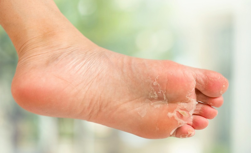 SB.. Understanding Foot Skin Peeling: Causes, Treatments, and Prevention Tips