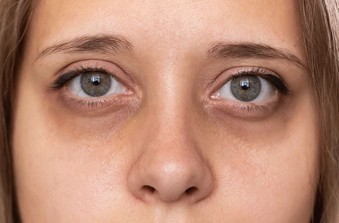 HT1. The Frightening Truth About Under-Eye Packs and Dark Circles: The Most Perilous Causes