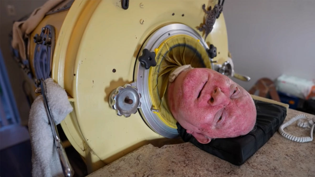 HT1. Paralyzed from polio at 6, he was one of the last people with an iron lung – but now there is a sad update