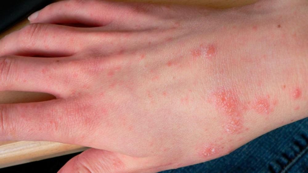 HT1. Understanding Scabies