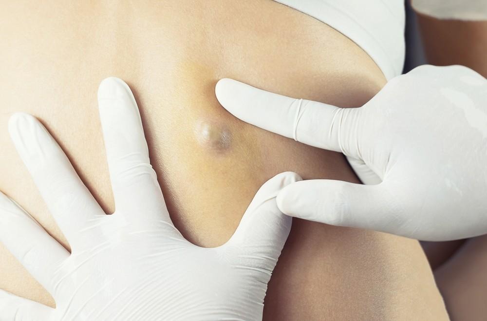 ST15. Understanding Skin Cysts: Causes, Treatments, and Medical Advice from Dermatologists