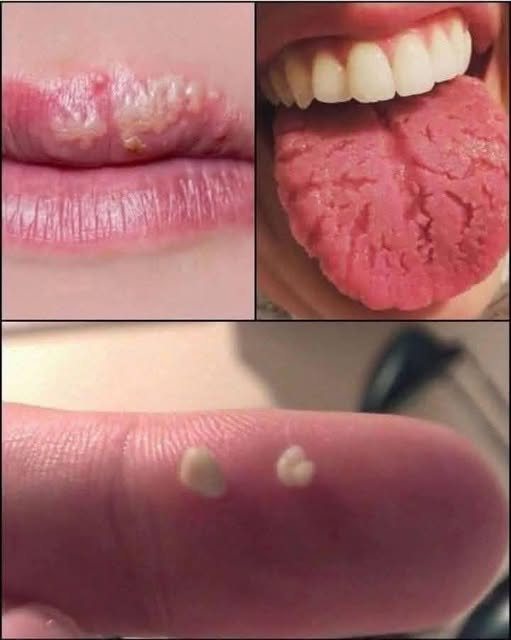 HT16. BE CAREFUL, if you get these bruises on your body, it means you have Ca…