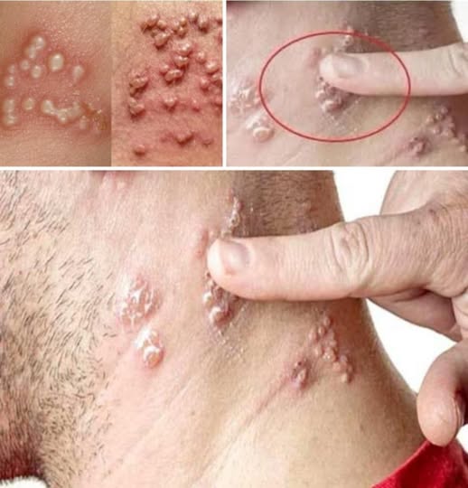 HT13. A man wakes up with small bubbles on his finger – After examining him, doctors called the police