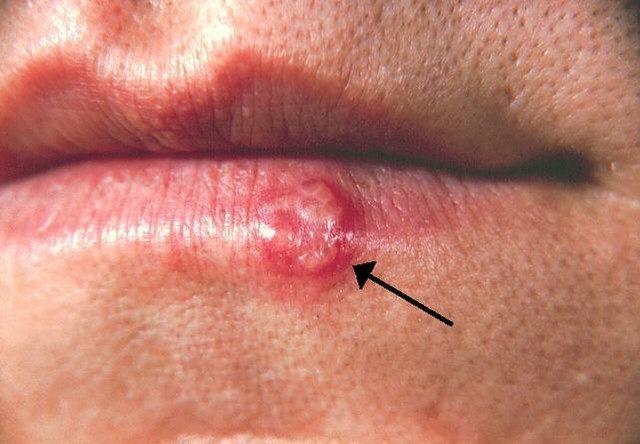 HT7. Most People Have Had or Have This Cold Sore Virus, But Very Few Know How to Cure It – Here’s What You Need to Do!