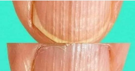 HT15. Having Striped Nails Could Mean That Your Body Is…