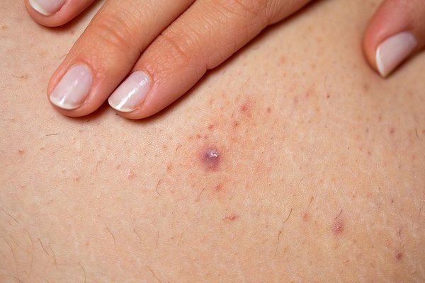 HT14. All the Symptoms of Stomach Cancer