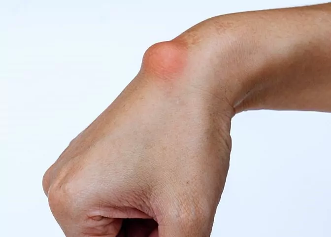 HT14. This Lump may Appear Due to Something you do Every day