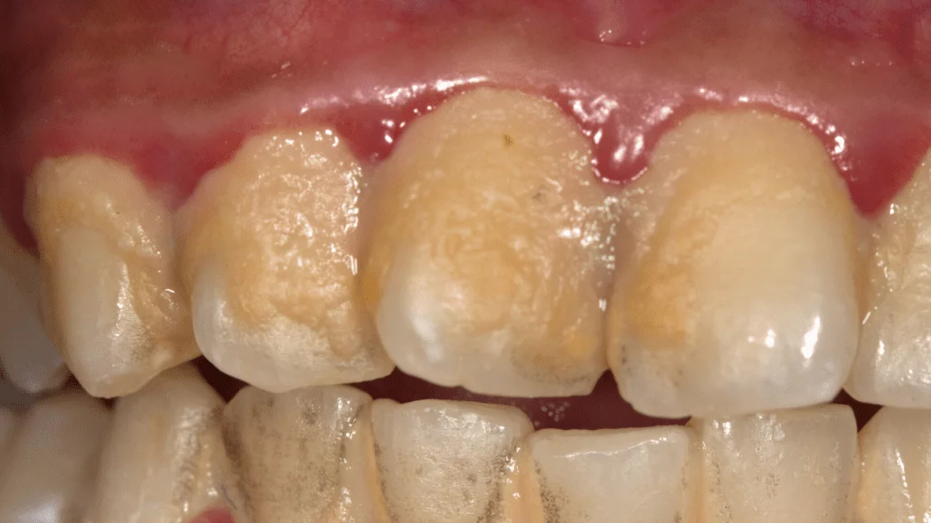 HT3. Be careful!! This is what your teeth will become when you eat…