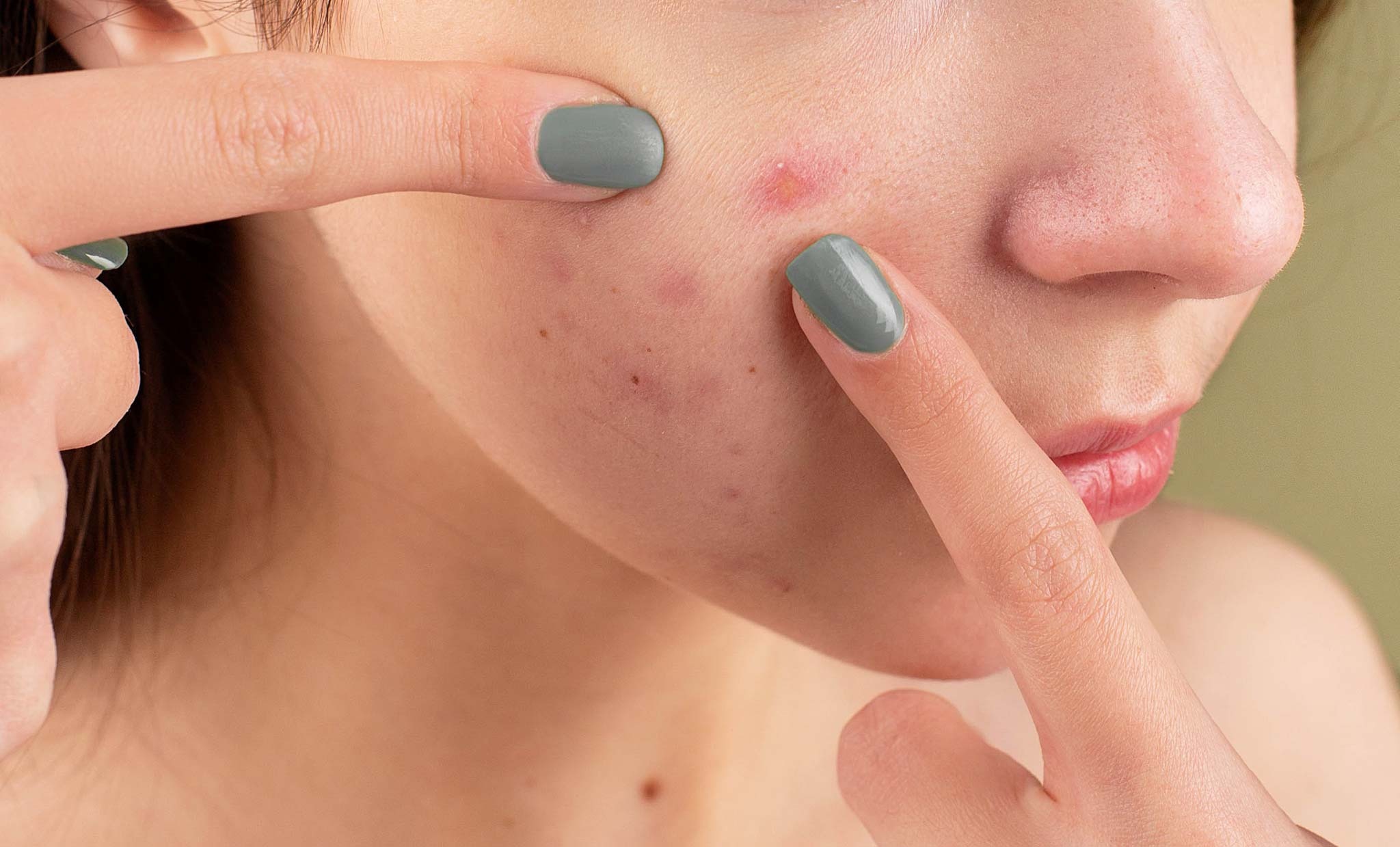 ST3. Experience a Soothing and Informative Journey When You Watch ‘Relax with Squeeze Acne’
