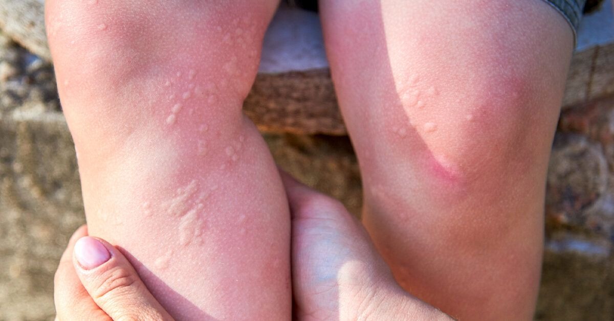 HT13. Unexplained Itching? What Your Body Is Trying to Tell You