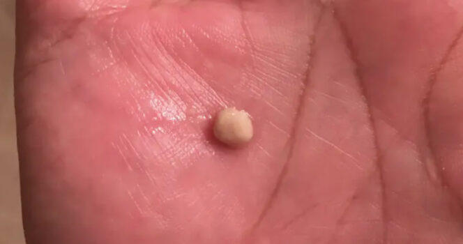 RF. Here’s what you need to know about tonsil stones – the weird pimple-like growths in your throat