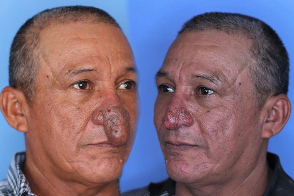 ST15. The Remarkable Transformation of Conrado’s Nose