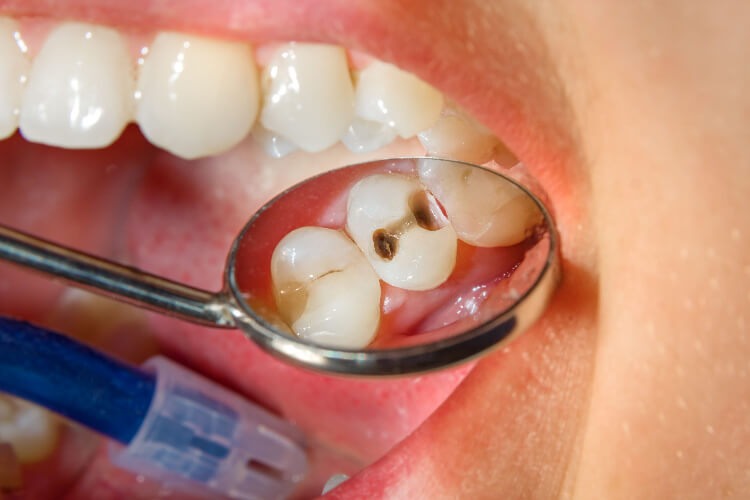 HT13. Heal Early Cavities Naturally: 6 Powerful Tips to Protect Your Smile