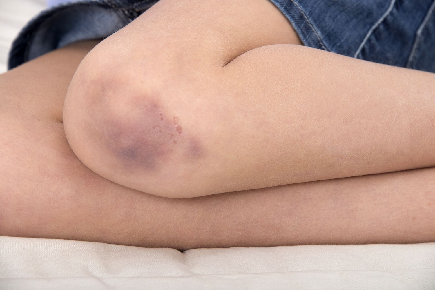 HT1. Little Girl’s Bruises Kept Getting Worse. When Mom Found Out The Truth, It Was Too Late…