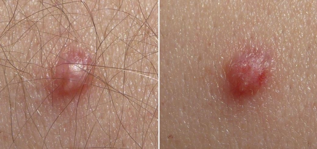 HT15. Signs of Human Papillomavirus You Should Know