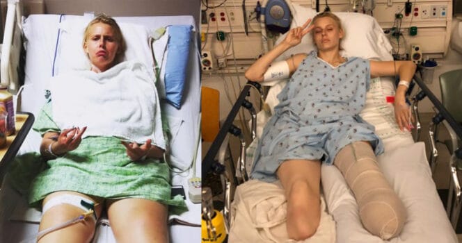 HT1. Her legs are amputated after using a common household product
