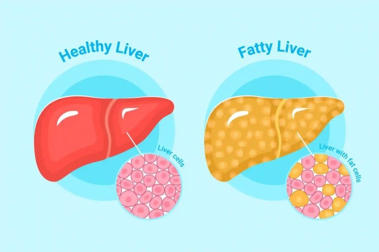 HT15. CLEANSES FATTY LIVER