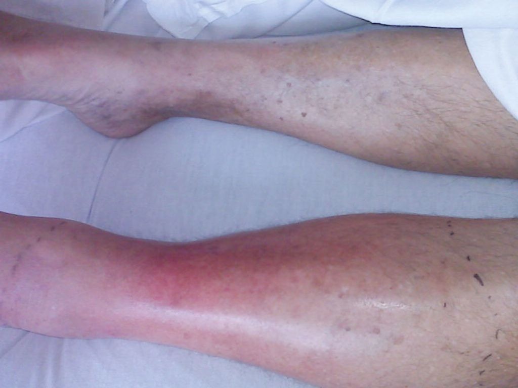 HT16. Attention: Recognizing Early Signs of Dangerous Infections