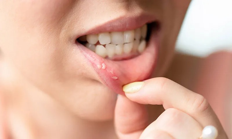 HT7. Don’t Underestimate It: Recognizing the Early Signs of Oral Can…