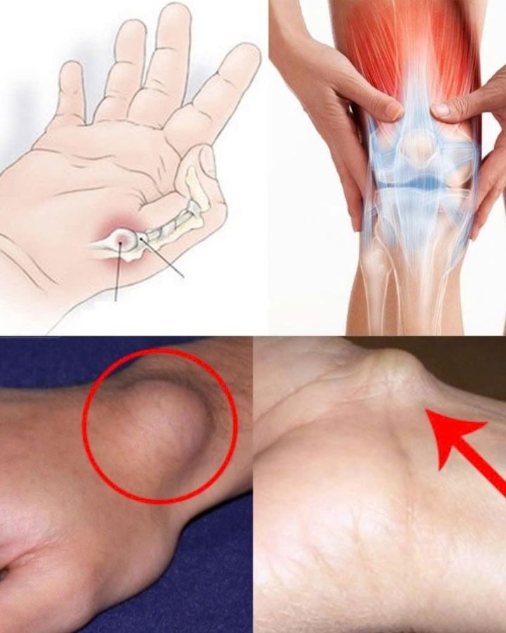 HT16. A Cyst on the Foot or Wrist: What You Should Know