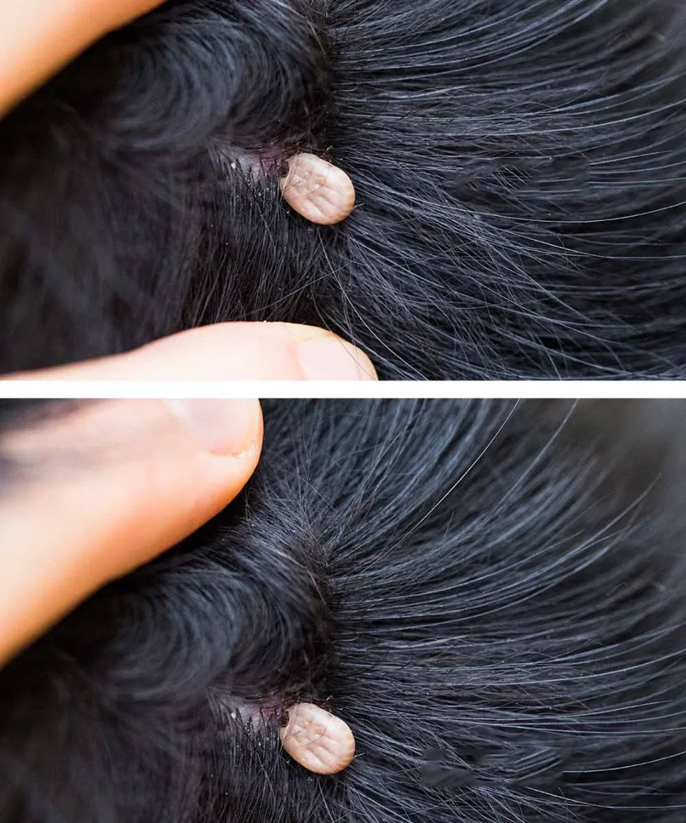 HT7. Just discovered this in my son’s hair. What is it? Not sure if we should go to doc