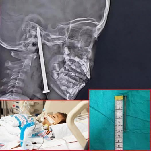 HT7. 7-Year-Old Boy Survives After 3-Inch Nail Pierces His Brain in Shocking Playground Accident