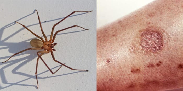HT1. What to do if you get bit.ten by a black widow spider: A complete guide