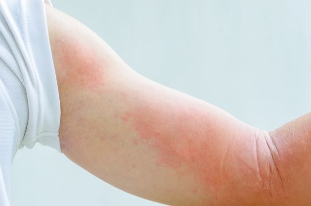 HT14. Her Whole Body Was Itchy: What She Thought Was a Common Allergy Was Hiding Something More Serious