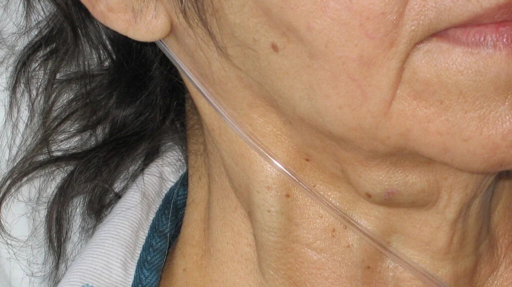 HT10. Massive jugular vein distension: a sign not to be ignored – Improve your life