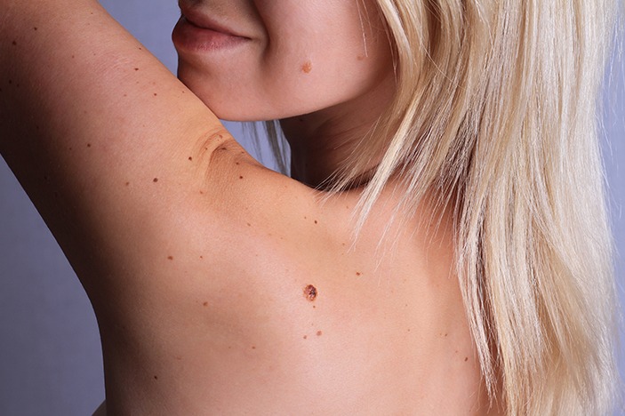 HT16. She Thought It Was Just a Mole… 77 Stitches Later, Doctors Told Her the Truth….