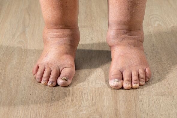 HT16. Health Warning Signs on Your Feet You Should Never Ignore