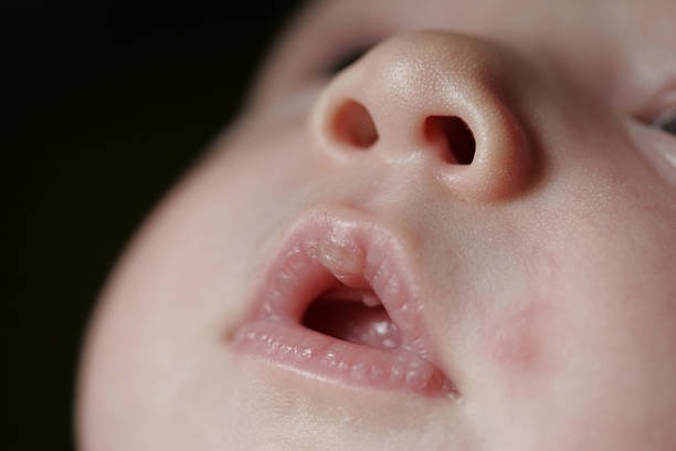 HT10. If your baby has these marks it means… See more s2