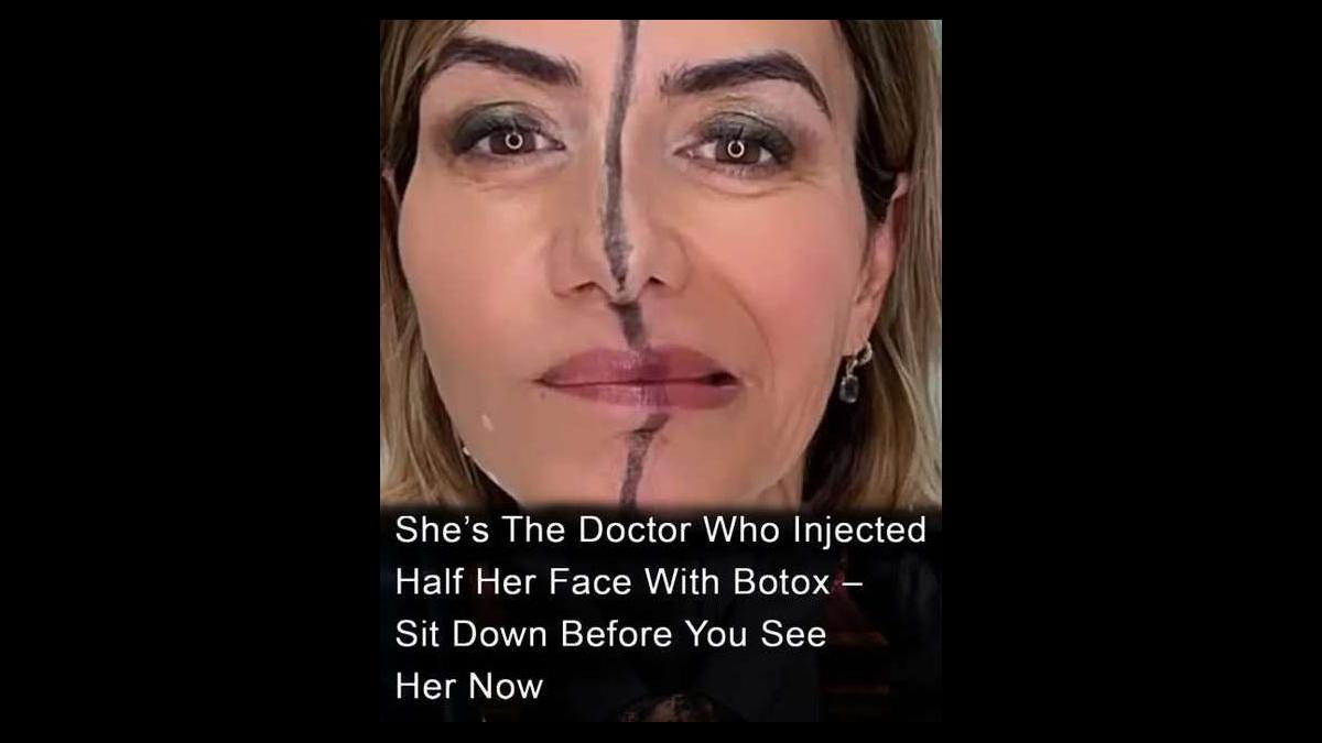 HT16. Doctor Injects Only Half Her Face With Botox—What Happened Next Might Surprise You