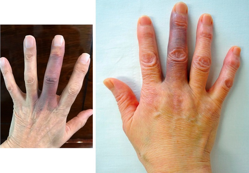 HT10. 3 Signs on Your Hands That Could Indicate Heart Disease or Cancer