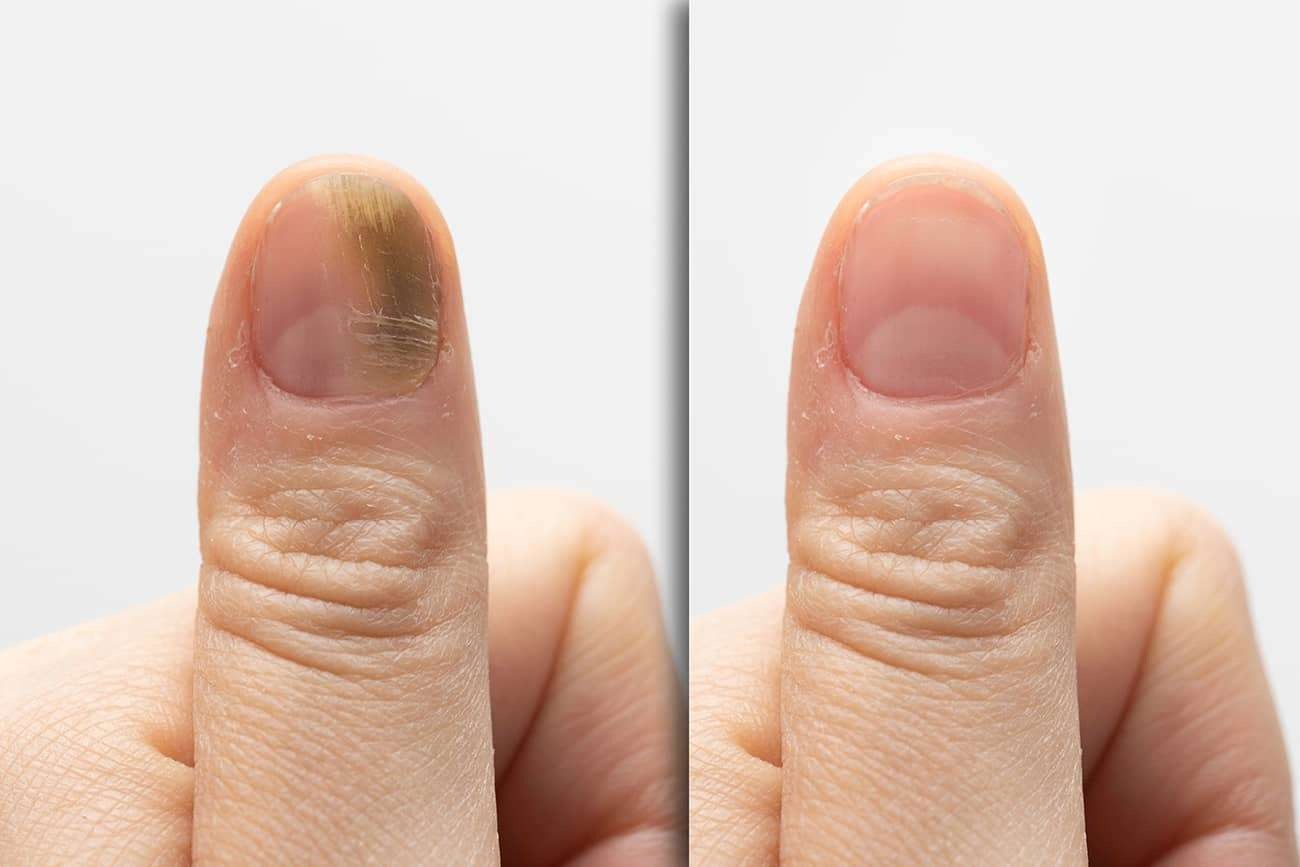 ST16. Fungal Nail Infection: Causes, Symptoms, and Effective Treatments