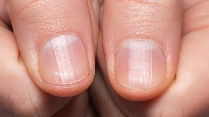 HT10. If You Notice These Lines on Your Nails After 40, Here’s What It Really Means