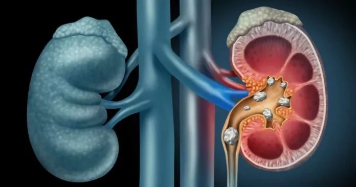 HT16. Warning Signs Your Kidneys Are in Danger – What to Watch For