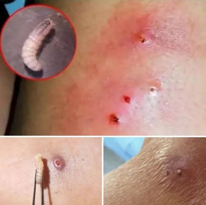 HT1. Larvae Found in Young Woman’s Body… How Did They Get There? (The Answer Will Horrify You)