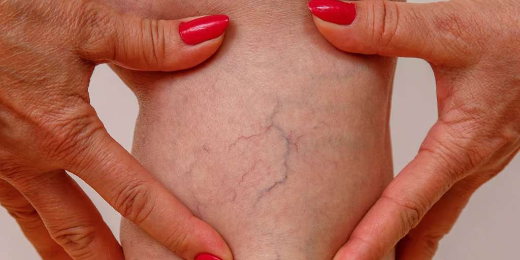 HT10. When to Worry About Suddenly Visible Veins: What Your Body May Be Telling You