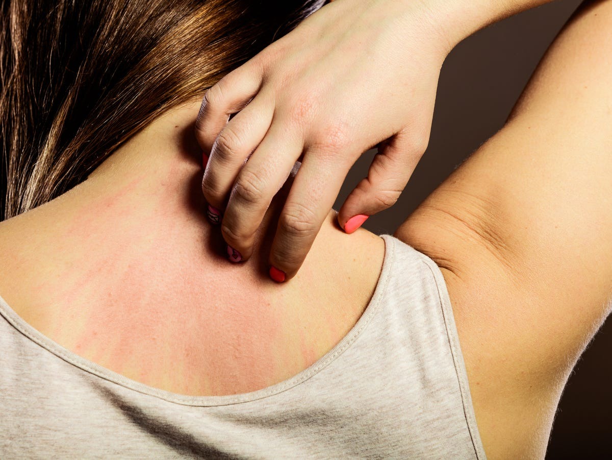 HT10. When Skin Irritations May Point to Something More