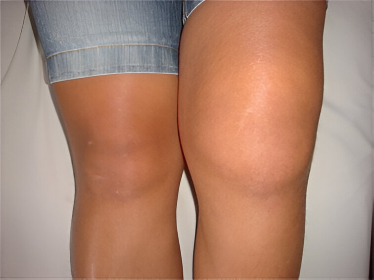 HT14. If you see one leg swollen, it is a sign of…