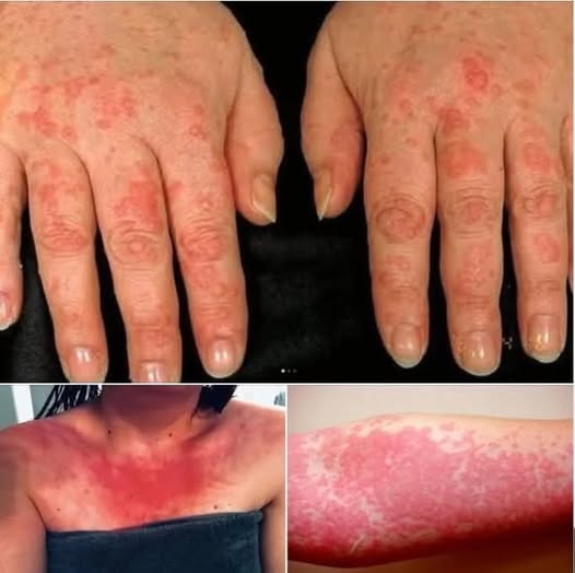 HT1. Red, Itchy, and Sweaty Skin are the consequences of having s… See more